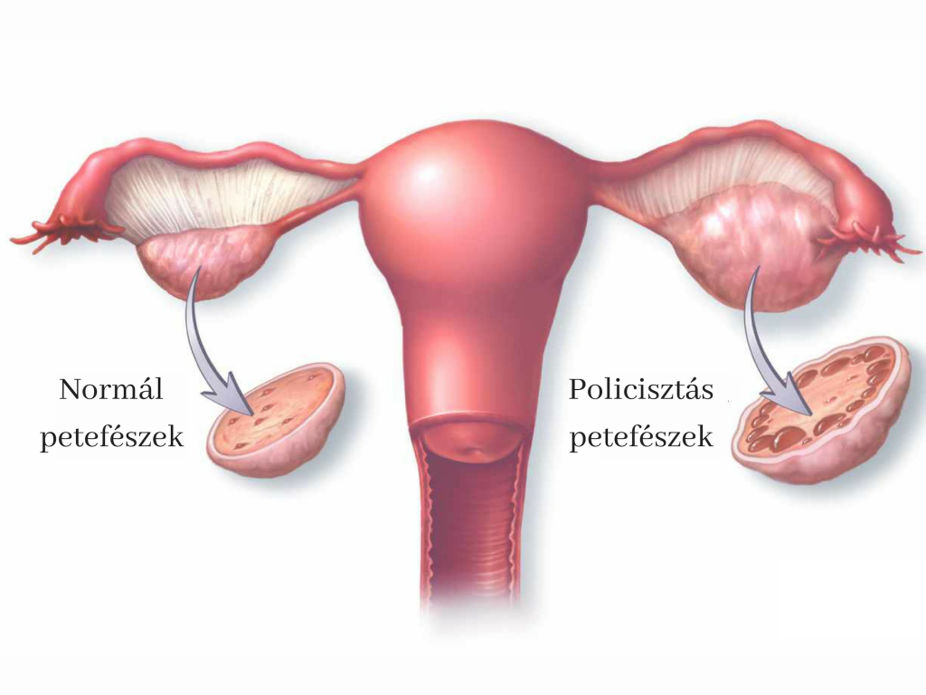 Így diétázzon PCOS esetén